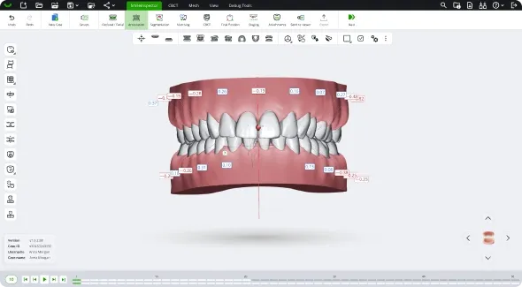 SmileInspector application window showing staged tooth movements for a lab workflow