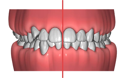 A case at the final position step in SmileInspector