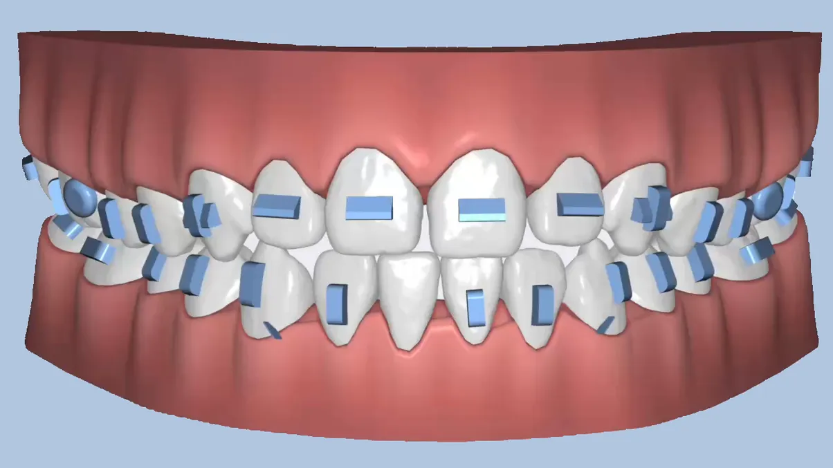 SmileInspector treatment planning — staged tooth movement preview