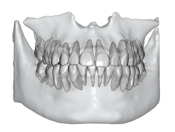 Intraoral scan overlaid with CBCT data revealing bone structure and tooth roots