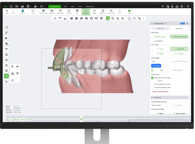 Overbite, overjet and dental discrepancy measurements shown on a scanned arch