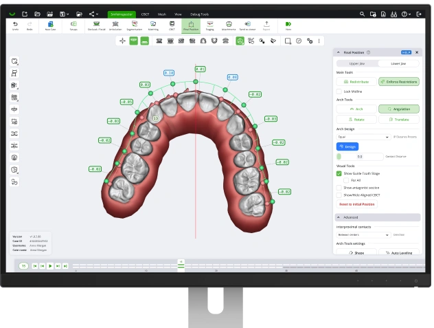 Final tooth positions refined with symmetry controls and midline visualization