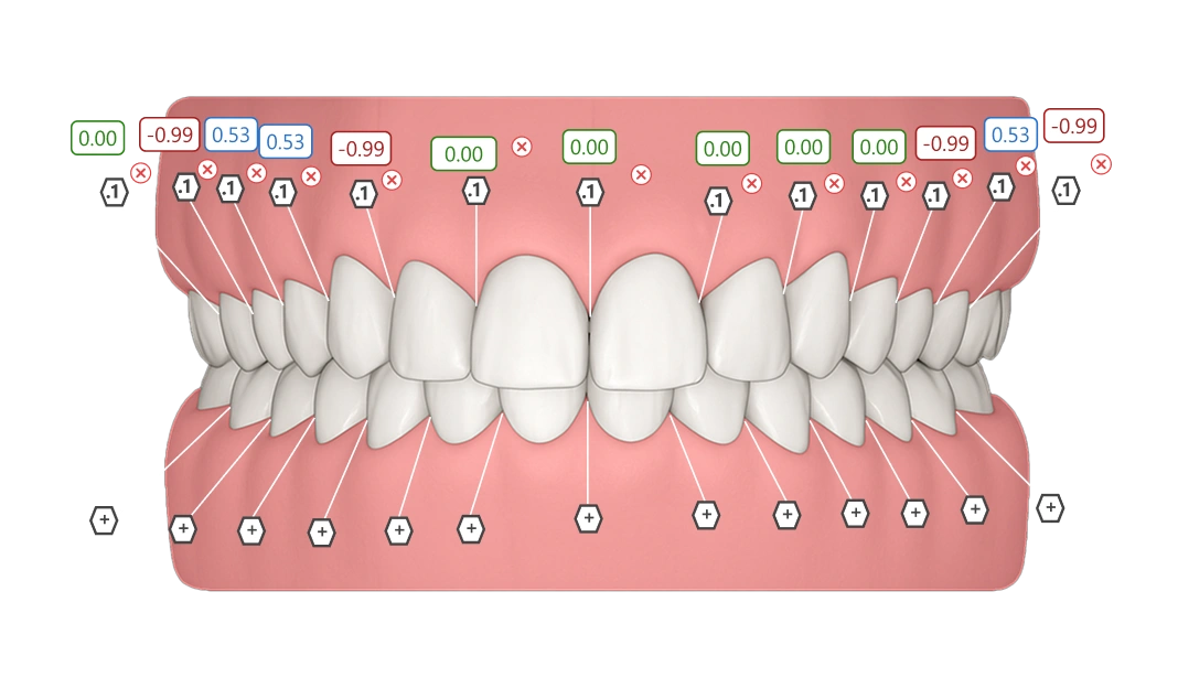 Interproximal Reduction