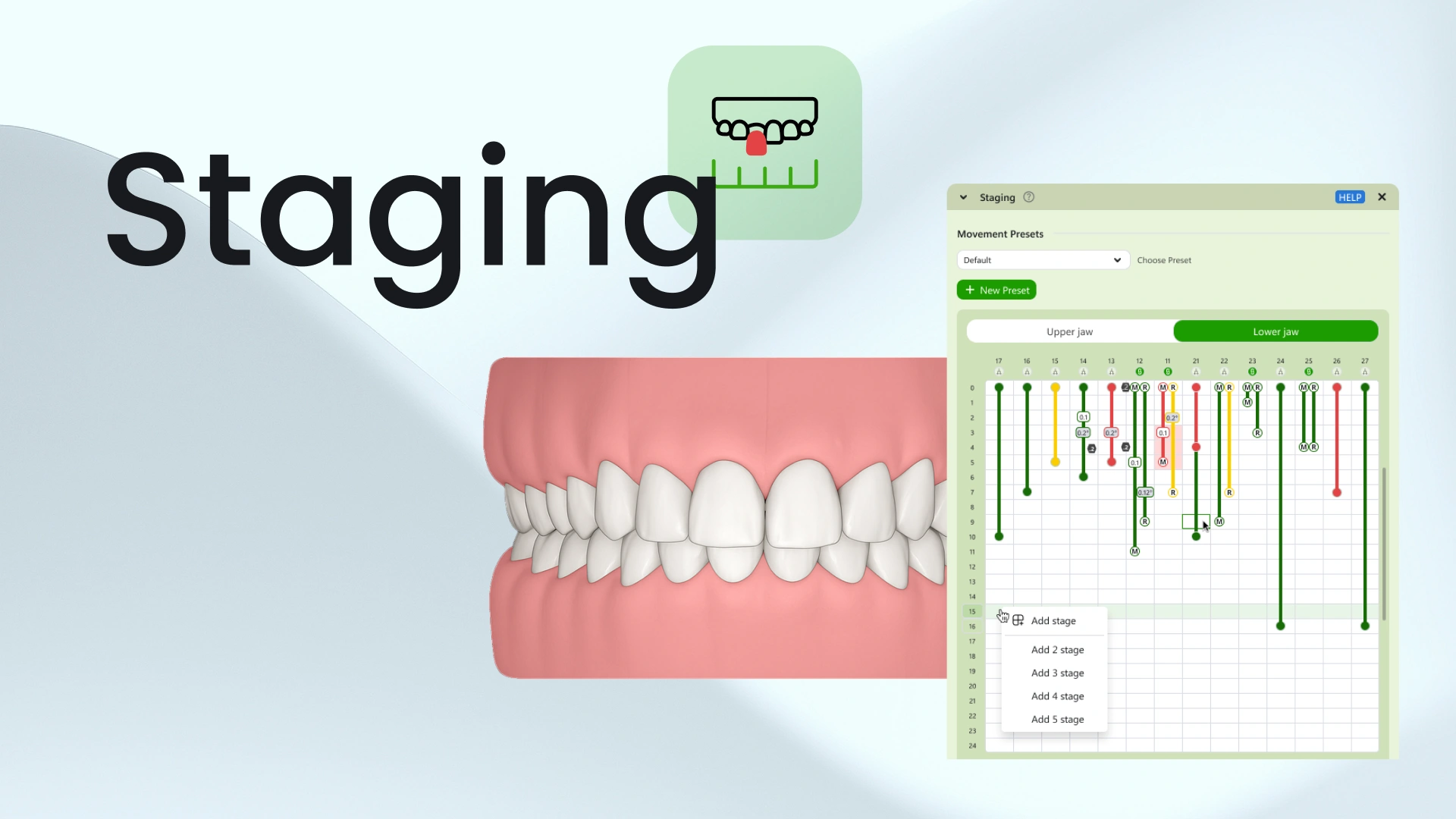 Planning Tooth Movements with Staging in SmileInspector