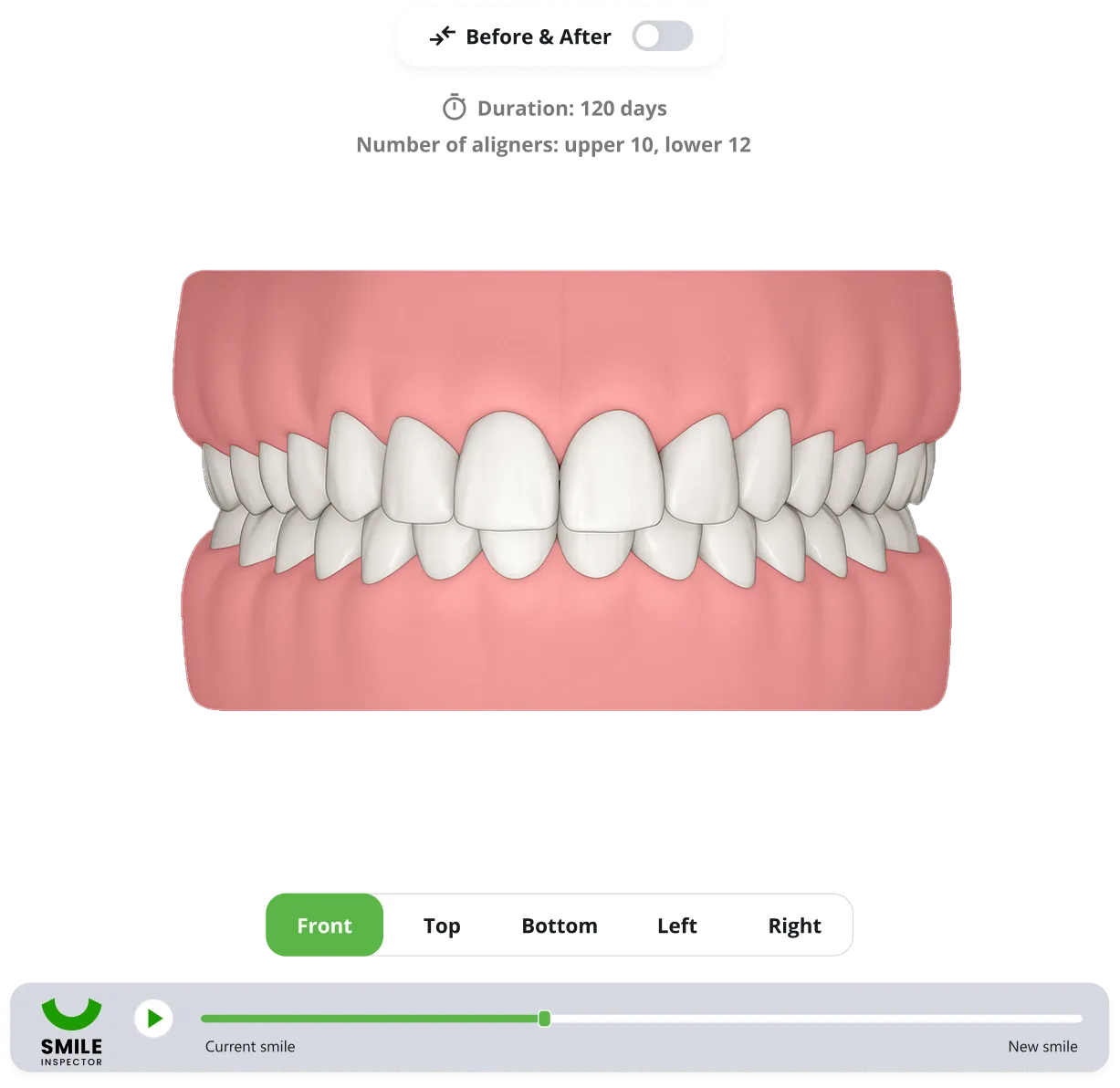 Before, after, and the number of aligners shown for the upper arch